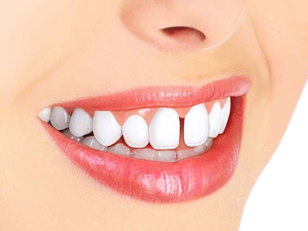 دیاستما یا فاصله بین دندانی چیست ؟