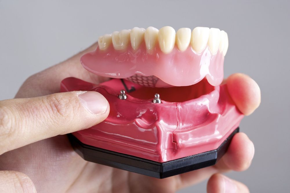 اوردنچر دندان بر پایه ایمپلنت