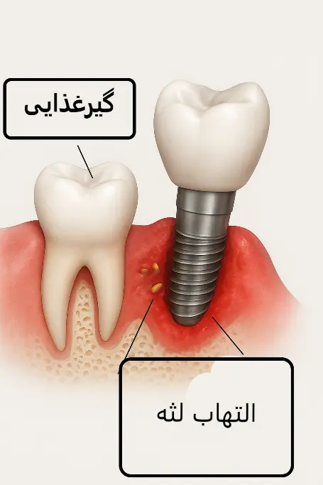مشکلات رها کردن فضای خالی دندان