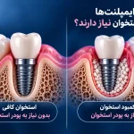 پودر استخوان در ایمپلنت
