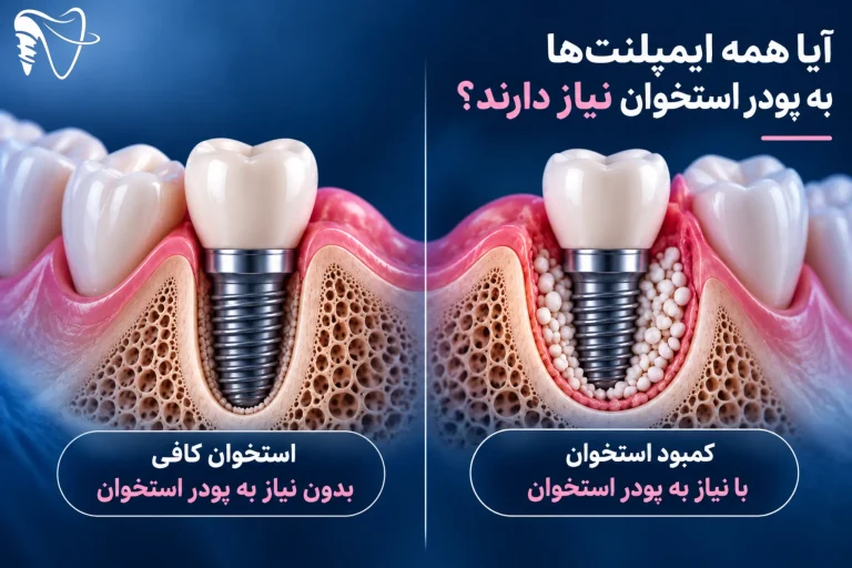 پودر استخوان در ایمپلنت