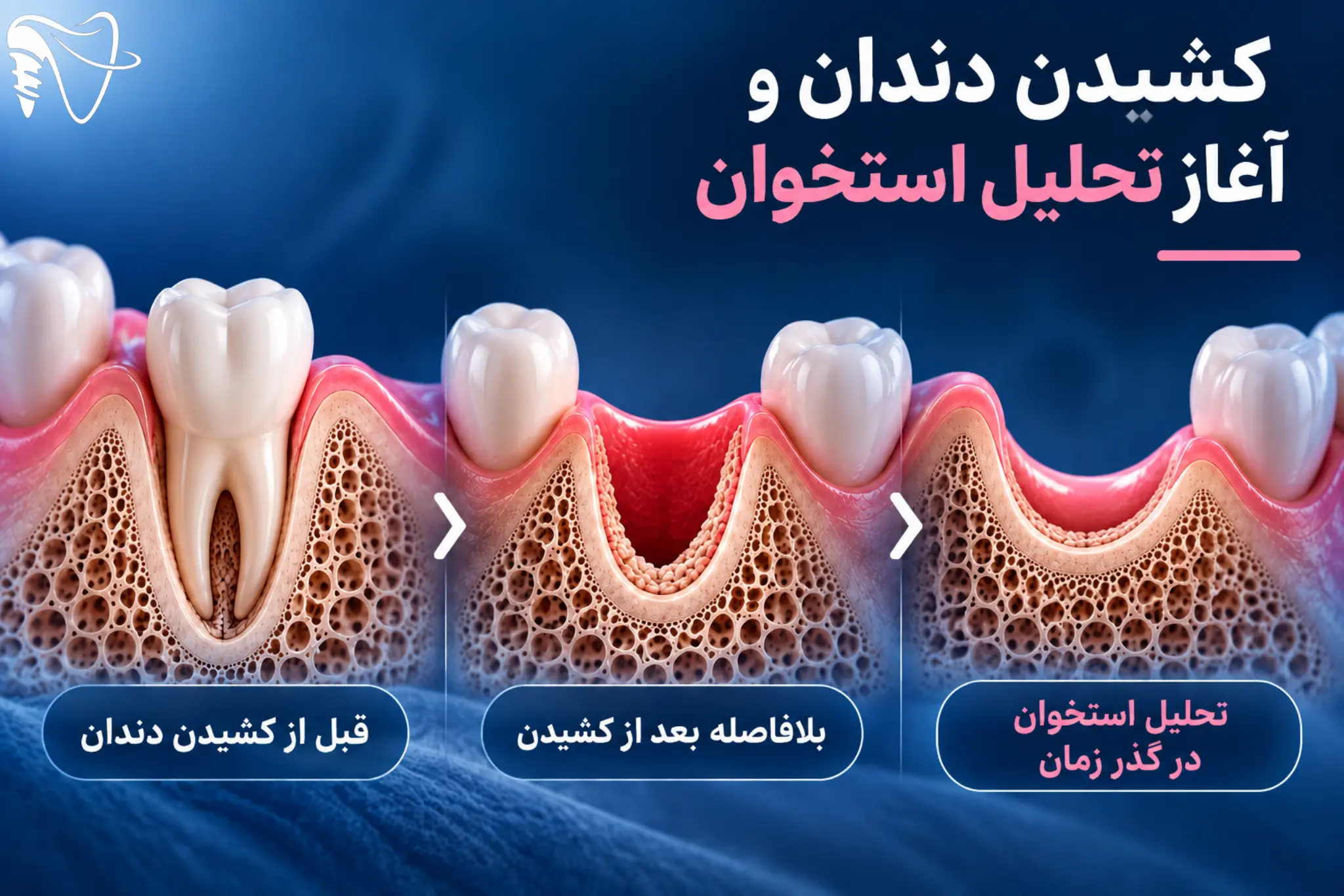 چه زمانی احتمال نیاز به پودر استخوان بیشتر می‌شود؟
