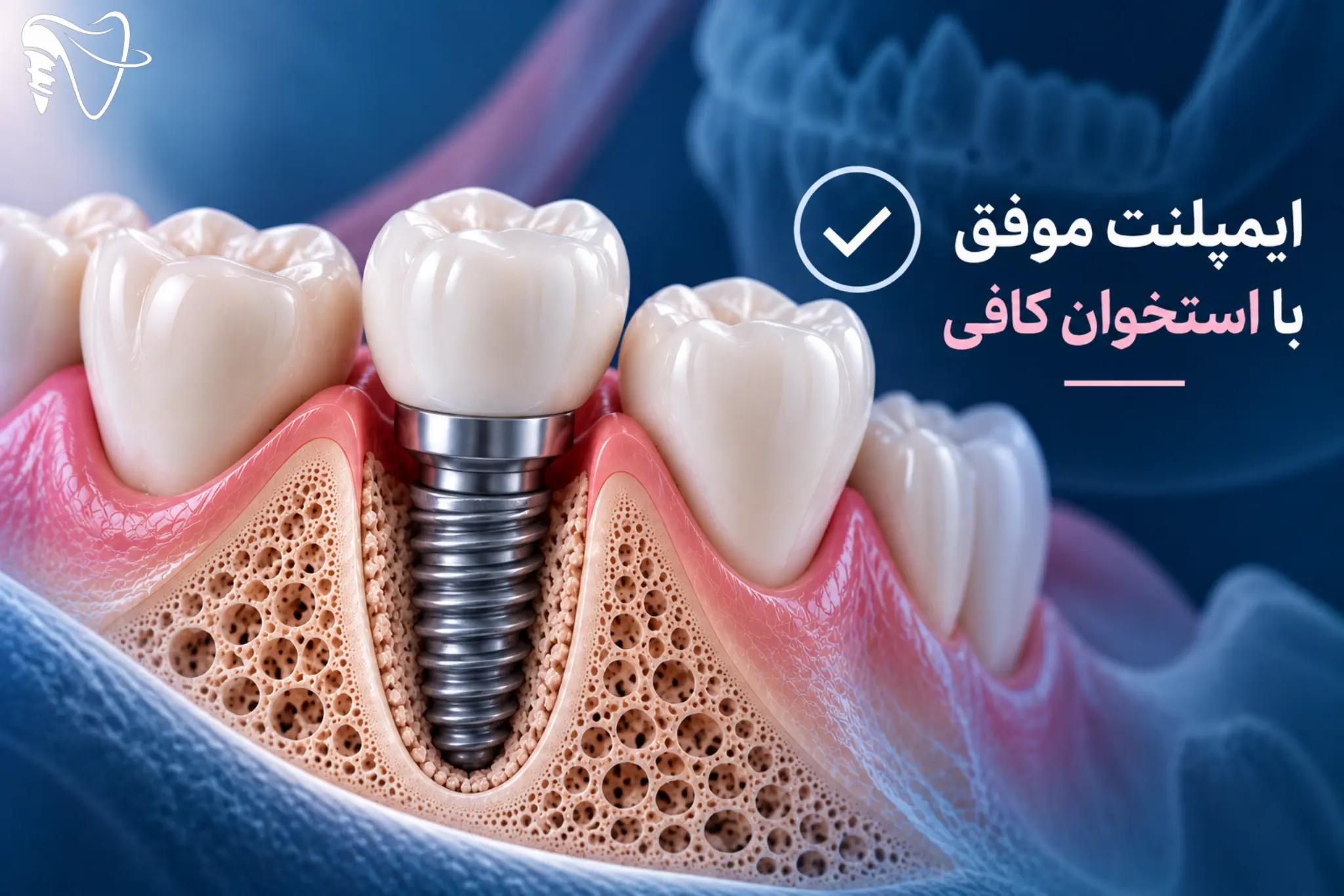 بهترین زمان برای تصمیم‌گیری درباره ایمپلنت چه زمانی است؟
