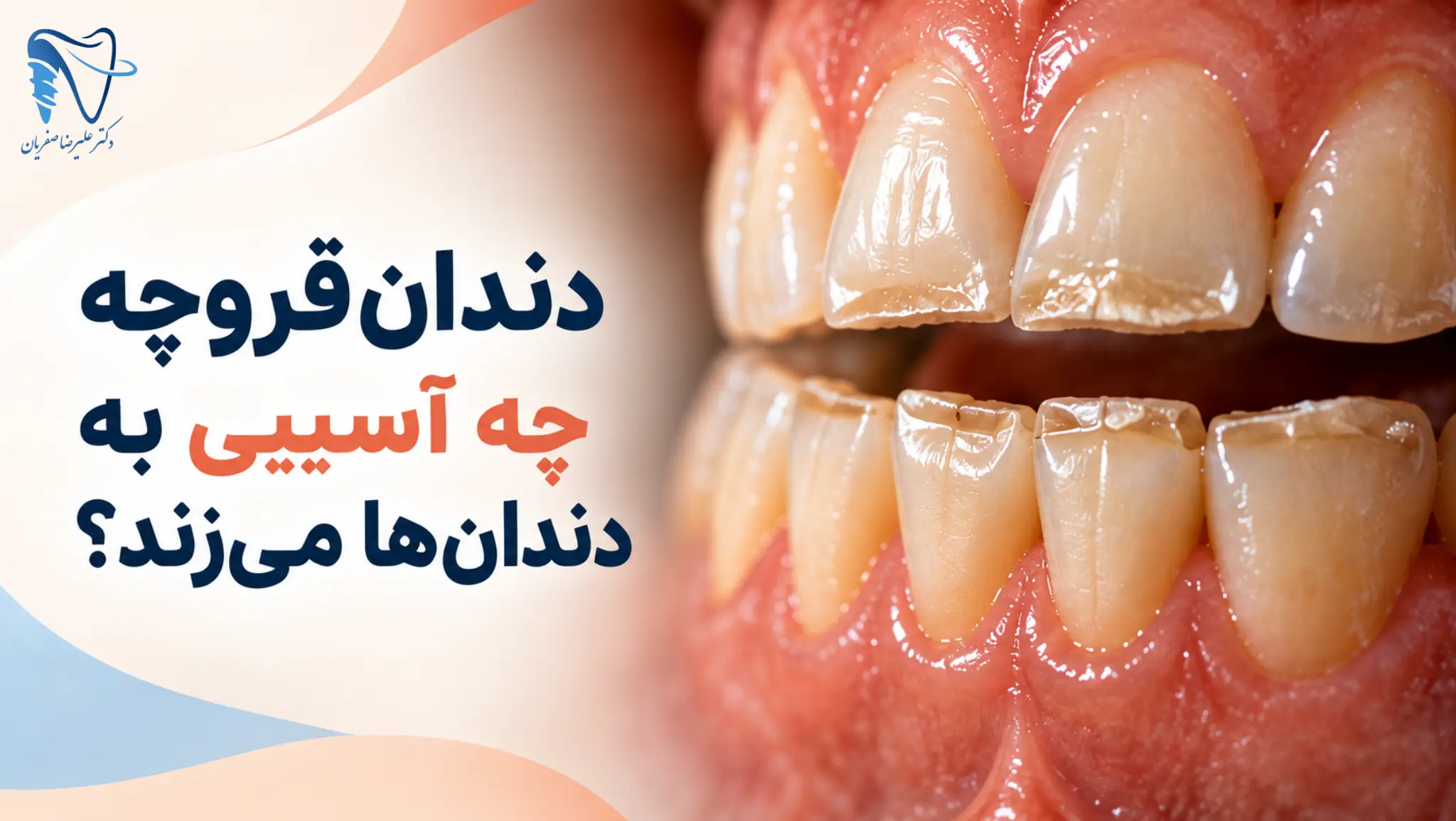 دندان‌قروچه چه آسیبی به دندان‌ها می‌زند؟